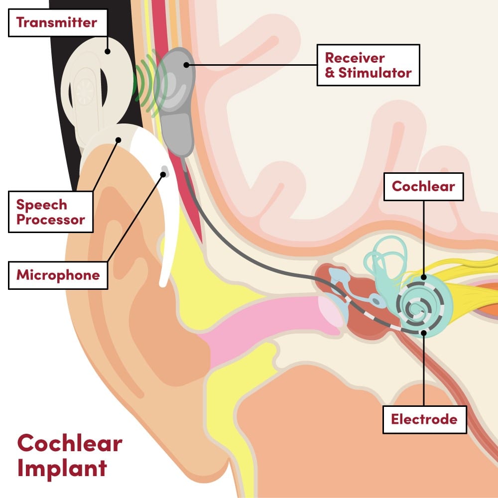 cochlear implant infographic