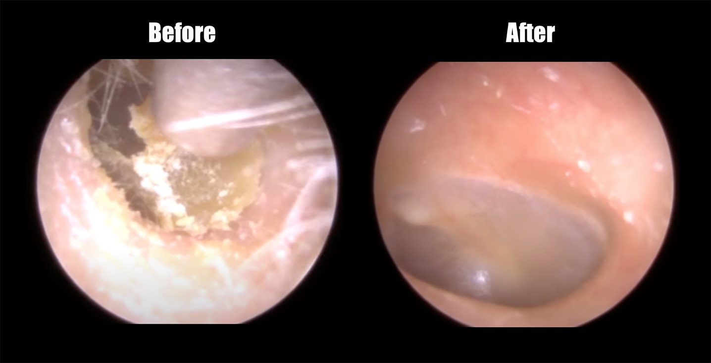 Before and after professional earwax removal and ear cleaning at Alaska Hearing & Tinnitus Center inside the ear image